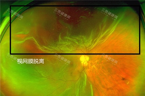 玻璃体后脱离引起的视网膜半脱怎么治？及时干预很重要，避免失明风险！