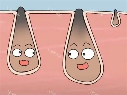 黑头毛囊