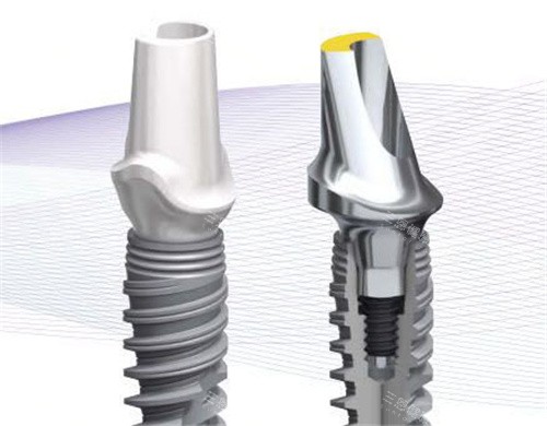 诺贝尔种植牙示意图 诺贝尔种植牙示意图
