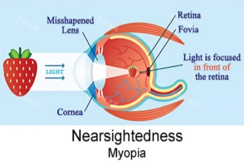 近视视物落在视网膜前