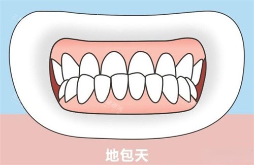 地包天是不是要做正颚手术？牙科医生拆解骨性/牙性差异，附不同年龄段治疗方案及价格
