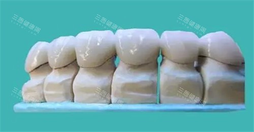 牙齿修复模型图 牙齿修复模型图