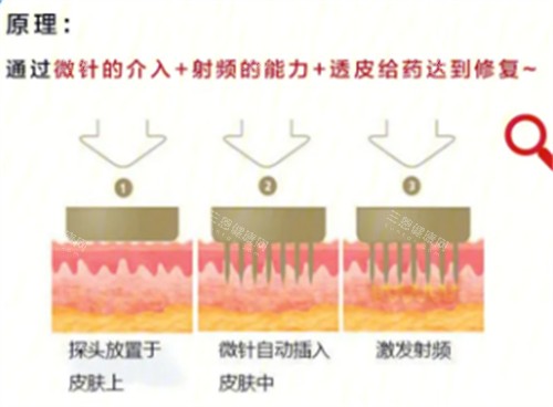 黄金微针原理分析 黄金微针原理分析