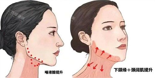 提升下颌线 提升下颌线