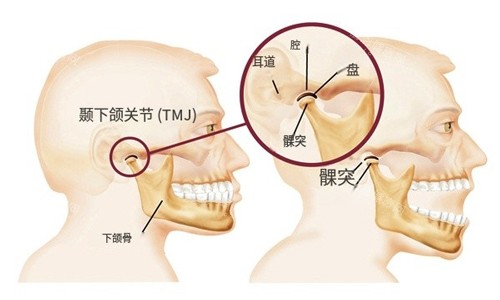 颞下颌关节紊乱示意图 颞下颌关节紊乱示意图