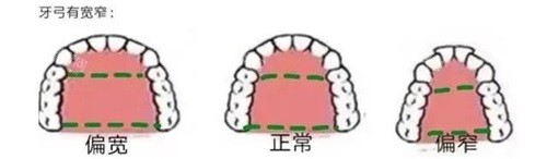 牙齿矫正牙弓形状 牙齿矫正牙弓形状