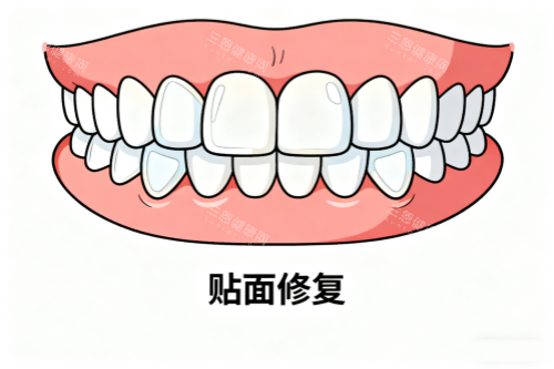 牙齿贴面修复卡通图 牙齿贴面修复卡通图