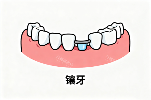 镶牙卡通图一览 镶牙卡通图一览