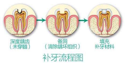 补牙流程图示意图 补牙流程图示意图