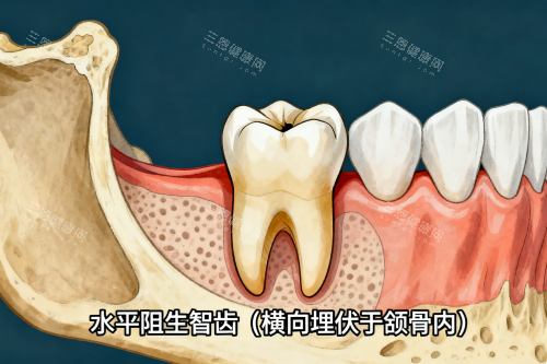 水平阻生智齿展示图 水平阻生智齿展示图