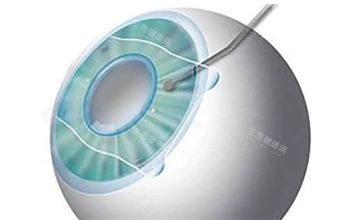 晶体植入近视手术费用多少钱？价格大概在18000元起！