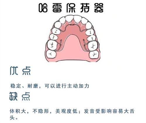 牙齿矫正哈雷保持器 牙齿矫正哈雷保持器