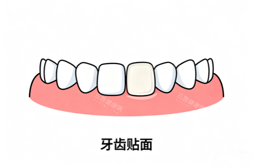 牙齿贴面卡通展示图 牙齿贴面卡通展示图