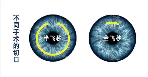 深圳深东爱尔眼科2025新价格！眼底手术12000起，验光仅80，值不值？