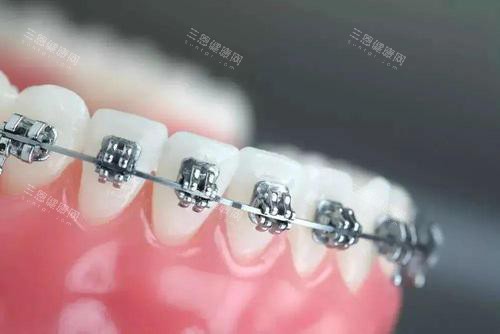 牙齿矫正牙套金属托槽矫正 牙齿矫正牙套金属托槽矫正
