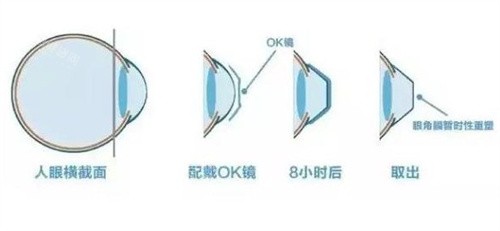 佩戴OK镜的原理 佩戴OK镜的原理