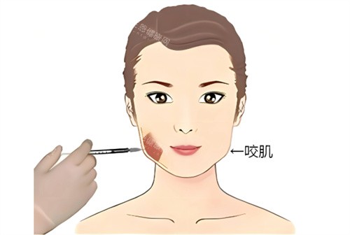 打针瘦脸