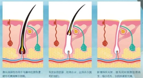 光子脱毛前后变化