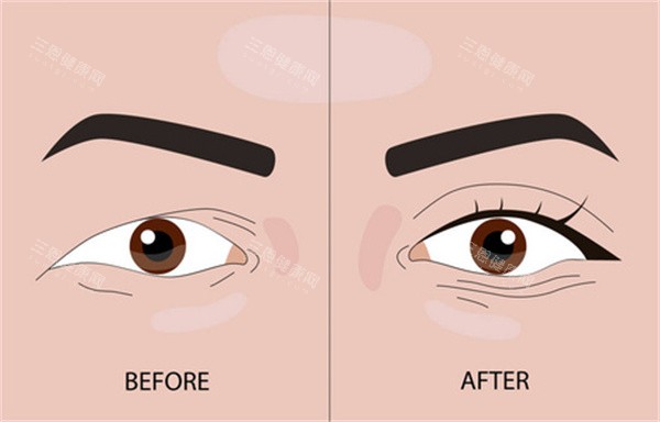 埋线双眼皮整形 埋线双眼皮整形