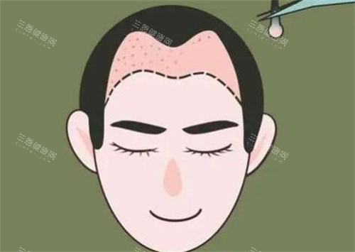 M型发际线种植 M型发际线种植