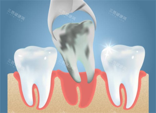 拔掉坏的牙齿 拔掉坏的牙齿