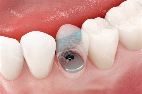 种植牙完成后透视图 种植牙完成后透视图