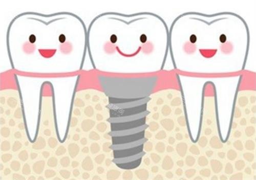 种植牙后动画展示图 种植牙后动画展示图