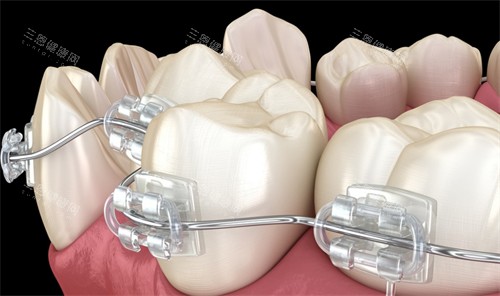 半隐形托槽牙齿矫正细节图