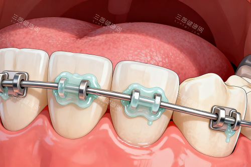 传统牙齿矫正方式一览