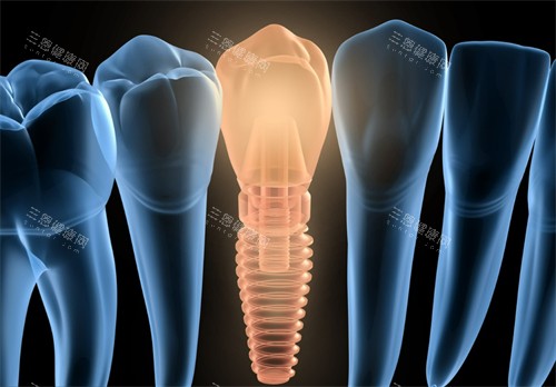 单颗种植牙动画图 单颗种植牙动画图