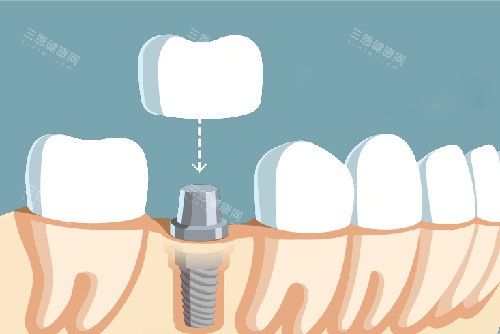单颗种植牙牙冠安装漫画图