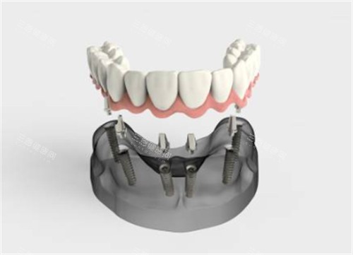 半口种植牙卡通图示意图