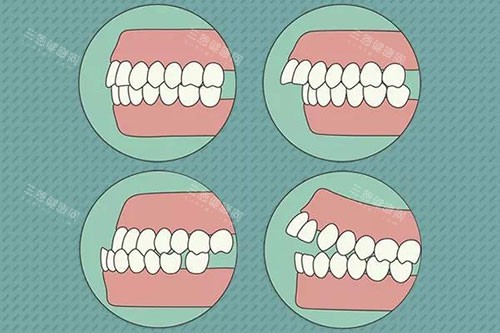 需要牙齿矫正的问题示意图
