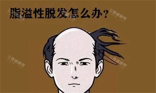脂溢性脱发怎么办 脂溢性脱发怎么办
