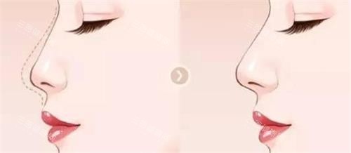 液态隆鼻后的成效