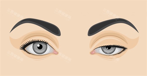 双眼皮修复前后对比 双眼皮修复前后对比