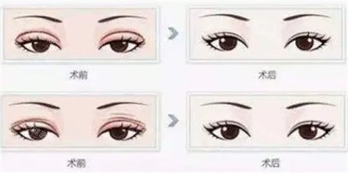 双眼皮修复 双眼皮修复