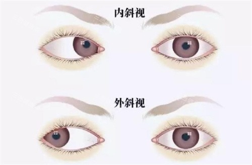 斜视图片 斜视图片