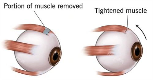 斜视眼睛肌肉和正常眼睛肌肉不同 斜视眼睛肌肉和正常眼睛肌肉不同