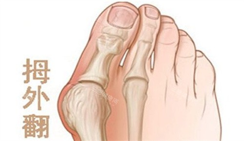 拇外翻 拇外翻