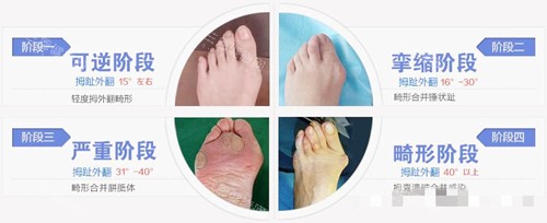 大脚骨类型 大脚骨类型