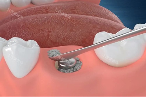 微创种植牙基台安装示意图 微创种植牙基台安装示意图