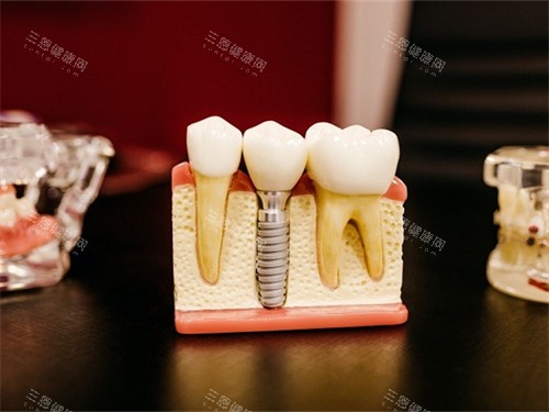 种植牙的牙齿模型展示图 种植牙的牙齿模型展示图