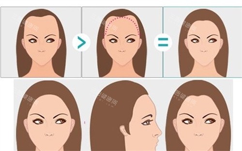 女性m型发际线卡通图 女性m型发际线卡通图