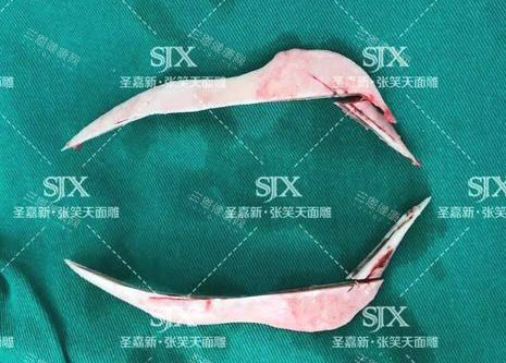 北京圣嘉新医疗美容医院张笑天下颌角手术截骨 北京圣嘉新医疗美容医院张笑天下颌角手术截骨