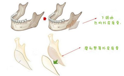 下颌角皮质骨截骨手术图片 下颌角皮质骨截骨手术图片