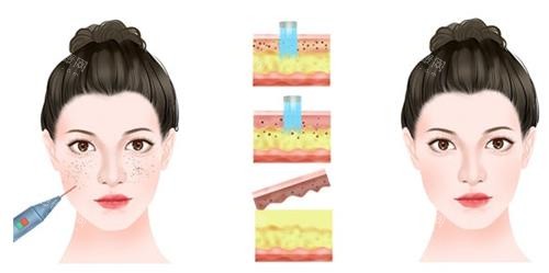 激光祛雀斑示意图