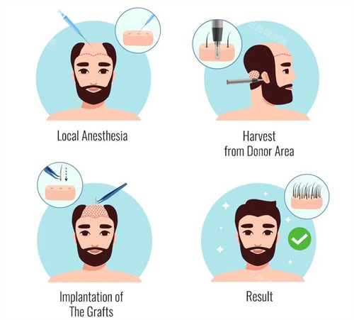 植发手术过程图一览 植发手术过程图一览