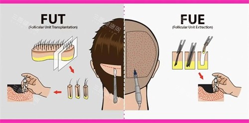 两种植发手术对比图 两种植发手术对比图
