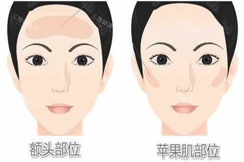 脂肪填充部位展示图